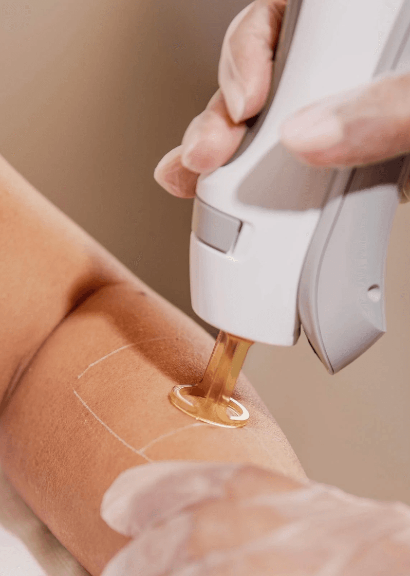 Laserontharing met de GentleMax Pro Plus: hoe werkt het en wat mag je verwachten? - 2